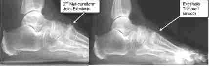 REMOVAL OF METATARSOCUNEIFORM JOINT EXOSTOSIS